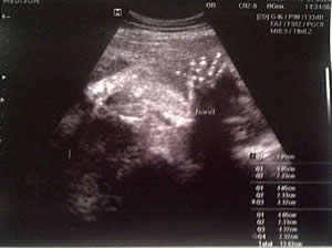 using binaural beats in pregnancy